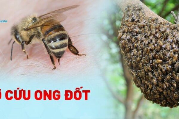 Cách sơ cứu ong đốt: Hướng dẫn xử trí đúng cách ngay tại nhà