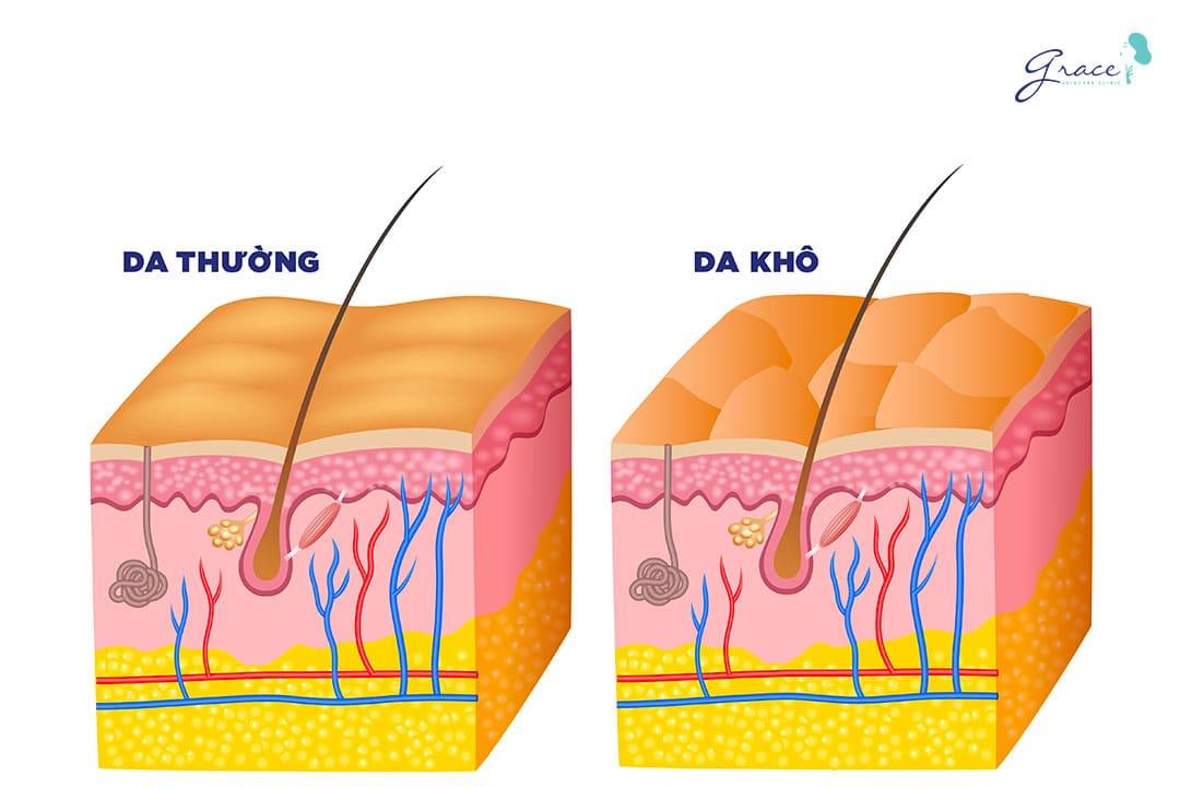 Tình trạng da khô có phải là triệu chứng thông thường như bạn vẫn nghĩ?