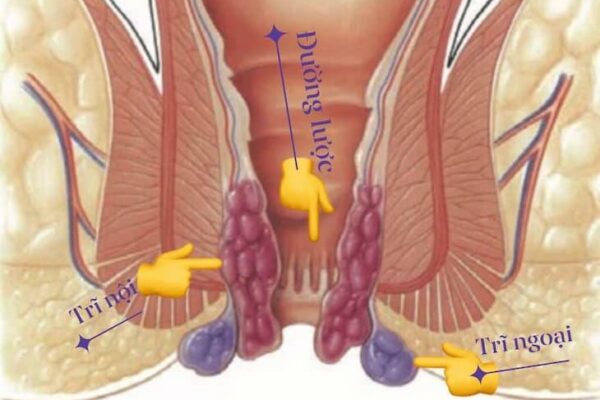 Trĩ ngoại là bệnh gì? Phân loại, dấu hiệu và cách điều trị