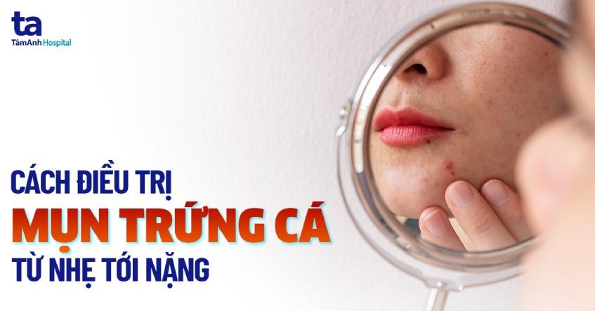 5 cách điều trị mụn trứng cá từ nhẹ đến nặng chi tiết cực an toàn