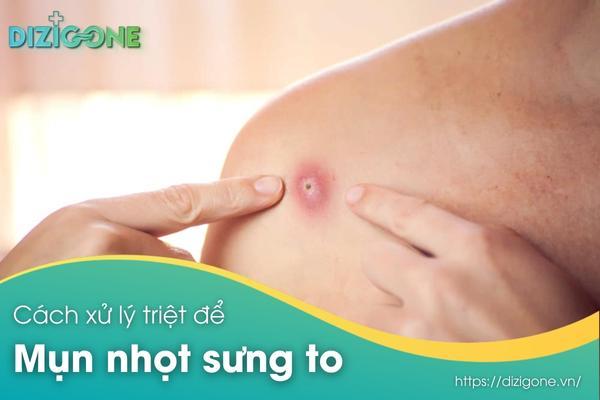 Mụn nhọt sưng to – Cách chữa triệt để