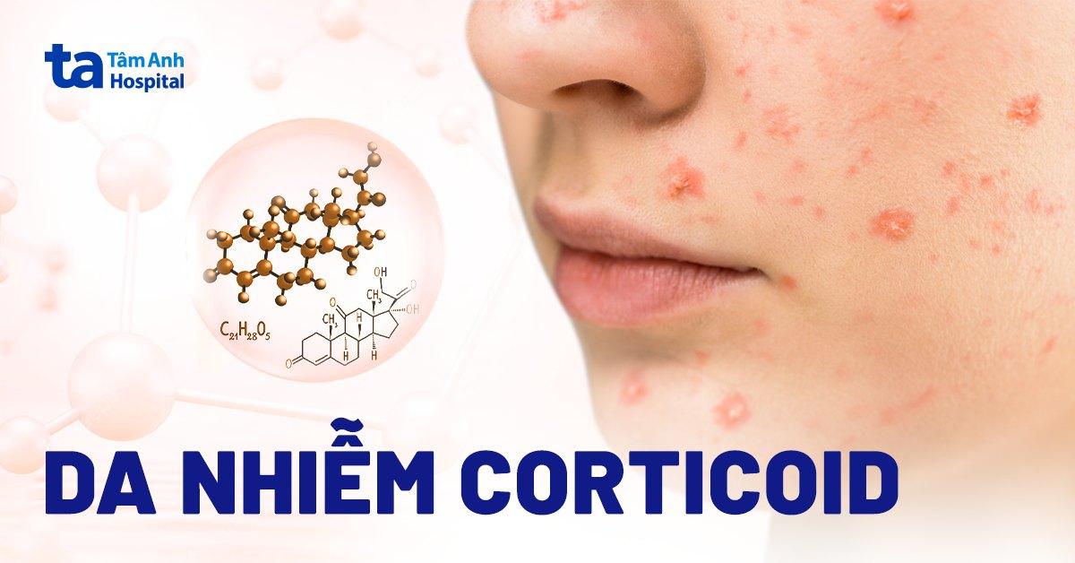 Da nhiễm Corticoid: Dấu hiệu, nguyên nhân và cách chăm sóc