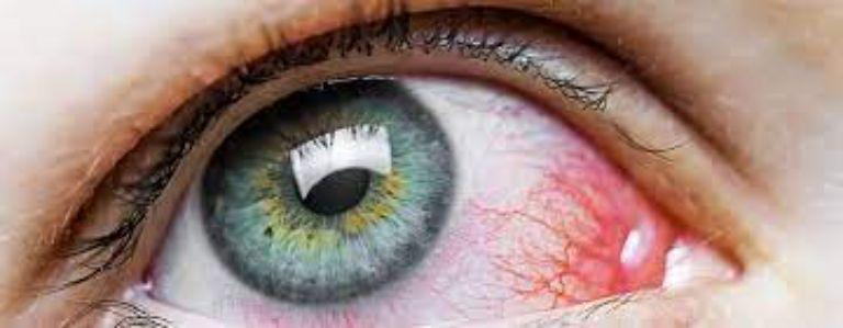 Mắt nổi gân đỏ là bệnh gì? Nguyên nhân, dấu hiệu, mức độ nguy hiểm