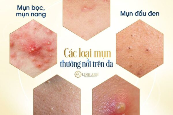 Mụn có tự hết không? Có nên nặn không? Cách chăm sóc giúp mụn mau hết Mụn có tự hết không? Có nên nặn không? Cách chăm sóc giúp mụn mau hết
