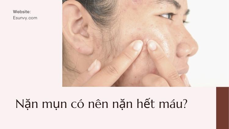 Nặn mụn có nên nặn hết máu?