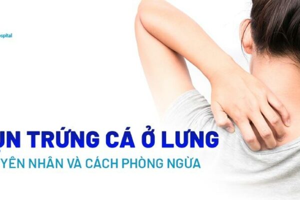 Mụn trứng cá ở lưng: Nguyên nhân, triệu chứng, cách phòng ngừa