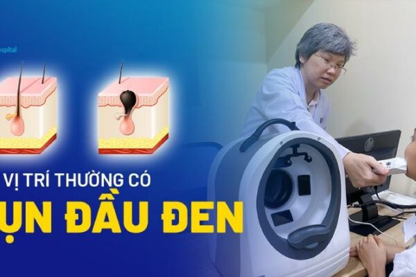 Mụn đầu đen là gì? Nguyên nhân và các vị trí “ưa thích” hay mọc