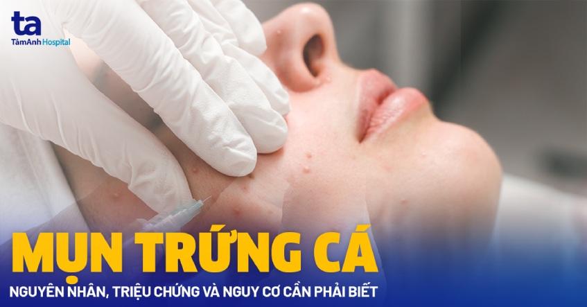 Mụn trứng cá: Nguyên nhân, triệu chứng và nguy cơ cần phải biết