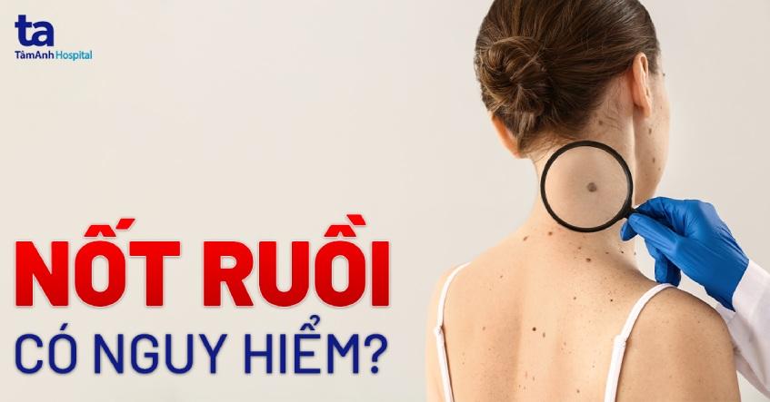 Nốt ruồi: Nguyên nhân, cơ chế hình thành và cách phân loại