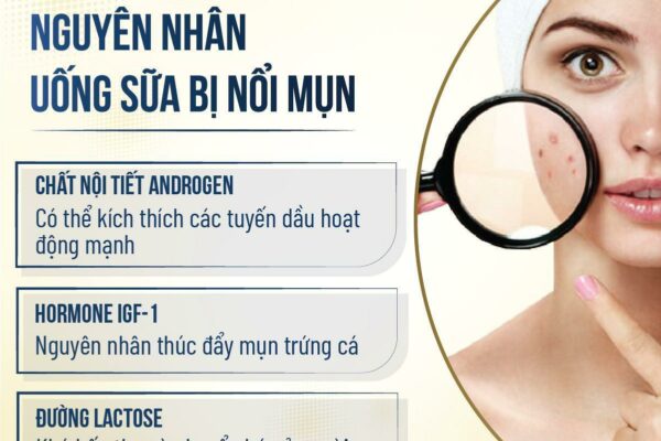 Uống sữa có nổi mụn không? Nên uống những loại sữa gì để đẹp da