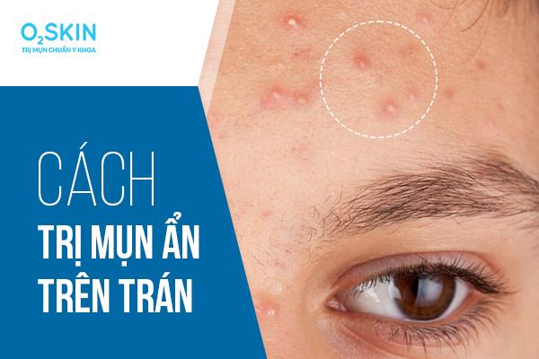 5 Cách trị mụn ở trán hiệu quả nhất