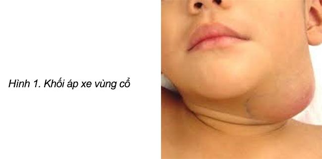 Khối vùng đầu – cổ ở trẻ em: Cách phát hiện và hướng xử trí