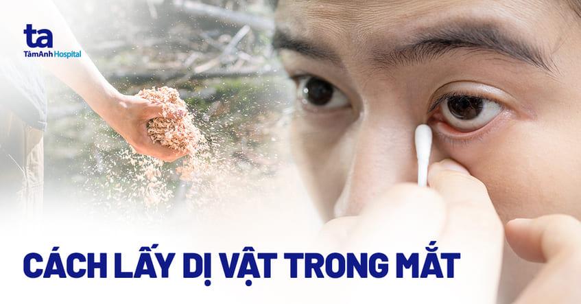 Cách lấy dị vật trong mắt ra an toàn và chăm sóc sau điều trị