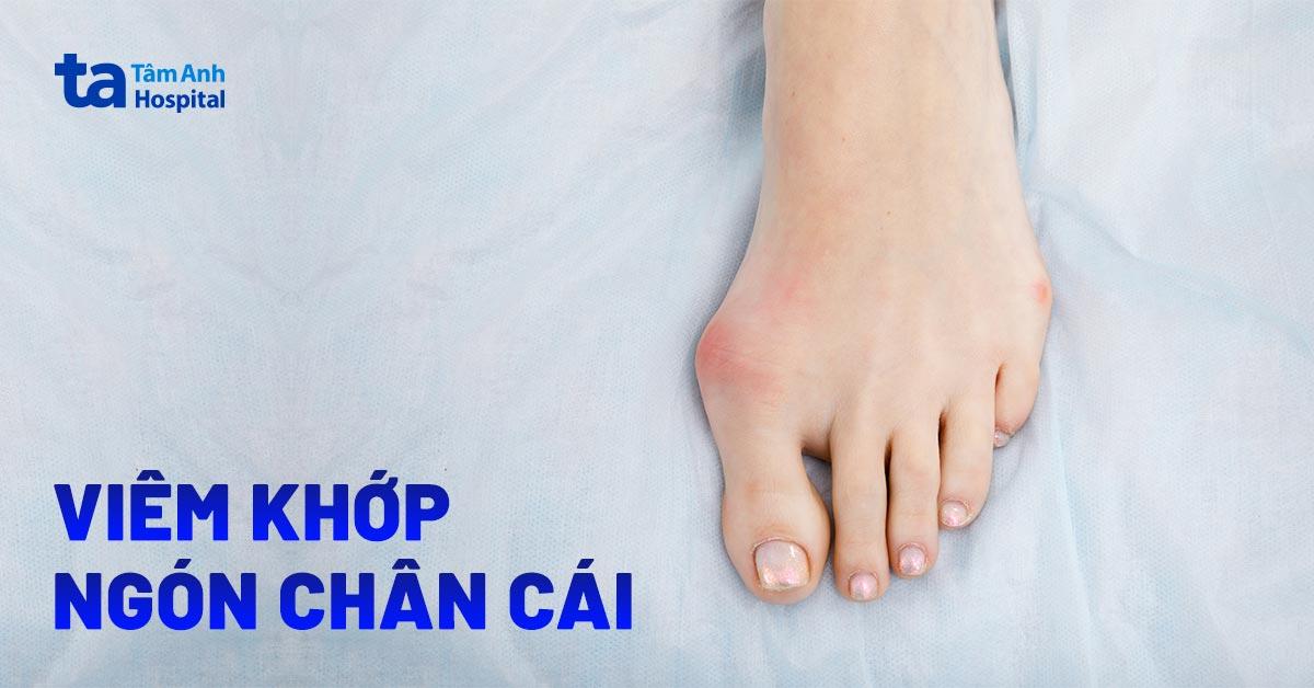 Viêm khớp ngón chân cái: Nguyên nhân, triệu chứng và điều trị