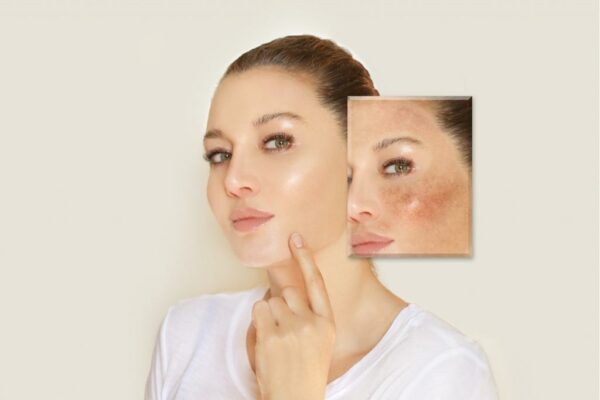 3 Giai đoạn khi dùng Retinol: từ bong tróc đến da đẹp mỹ mãn 3 Giai đoạn khi dùng Retinol: từ bong tróc đến da đẹp mỹ mãn