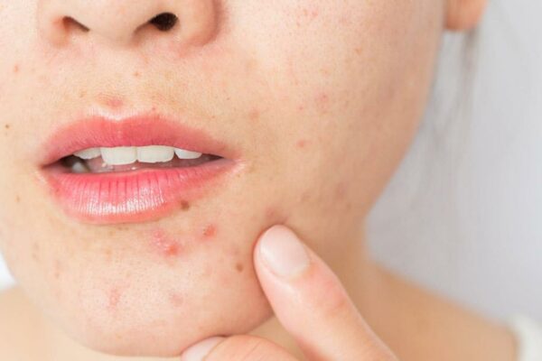 Cách xử lý mụn viêm tại nhà hiệu quả và cách phòng ngừa