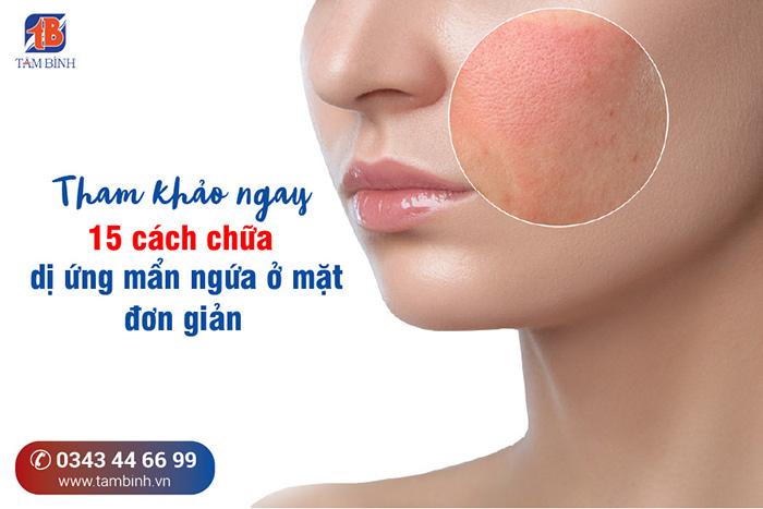 Tham khảo ngay 15 cách chữa dị ứng mẩn ngứa ở mặt đơn giản