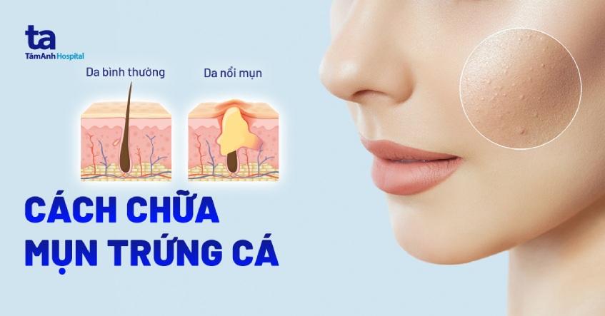 13 cách trị mụn trứng cá tại nhà từ thiên nhiên hiệu quả cao