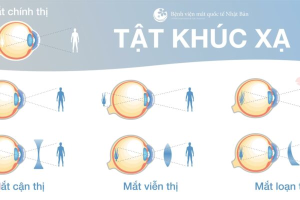 NÊN ĐEO KÍNH THƯỜNG XUYÊN HAY KHÔNG?