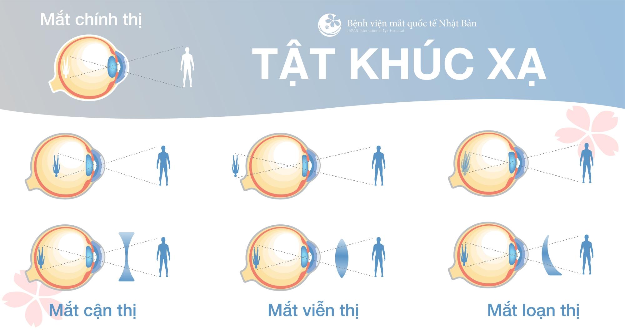 NÊN ĐEO KÍNH THƯỜNG XUYÊN HAY KHÔNG?