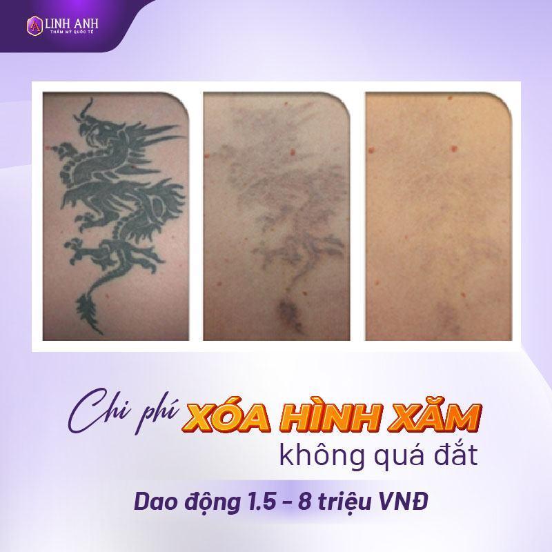 Chi phí xóa hình xăm bao nhiêu tiền? Bảng giá xóa xăm mới nhất 2023