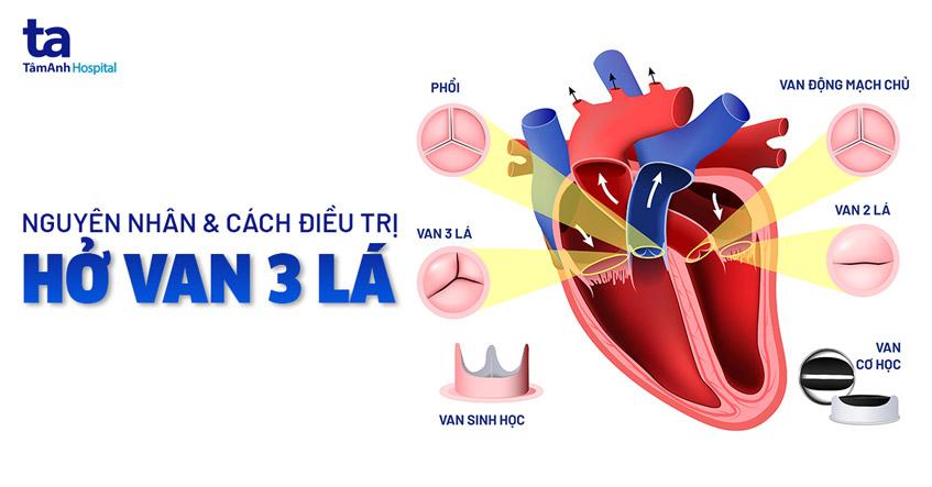 Hở van 3 lá: Nguyên nhân, triệu chứng và cách điều trị