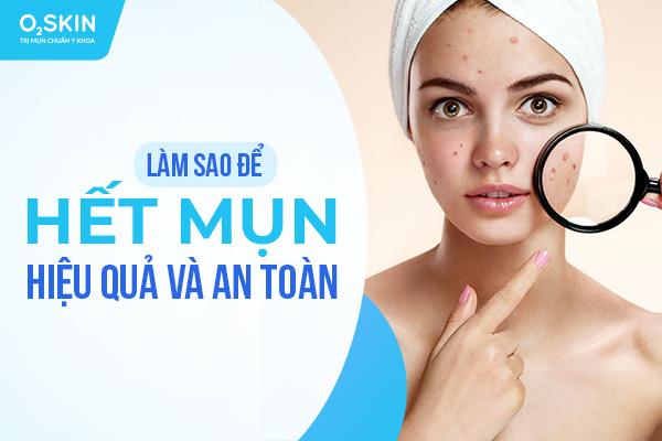 Làm sao để hết mụn hiệu quả và an toàn?