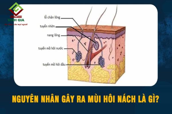 Hôi nách là gì? Nguyên nhân, triệu chứng và cách phòng