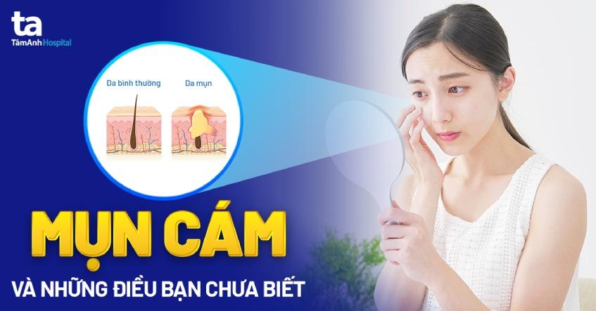 Mụn cám là gì? Nguyên nhân và các vị trí mọc “ưa thích”