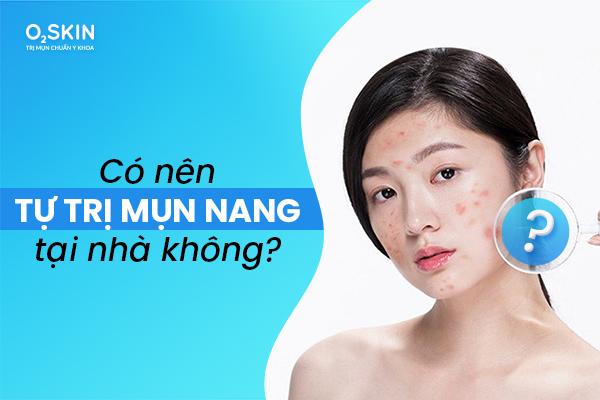 Tự Trị Mụn Nang Tại Nhà – Có Nên Không?