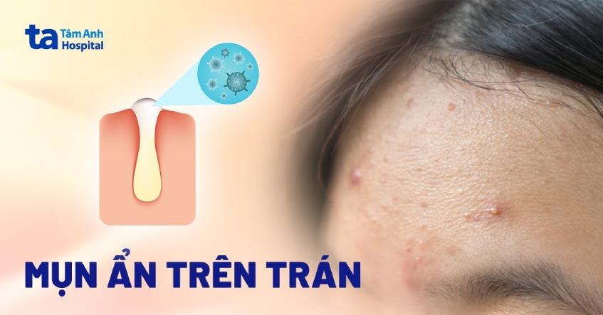 Nổi mụn ẩn trên trán: Nguyên nhân, dấu hiệu, chẩn đoán, phòng ngừa