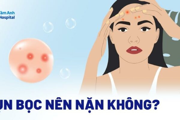 Mụn bọc có nên nặn không? Khi nào thì nặn được? Đặc điểm nhận dạng