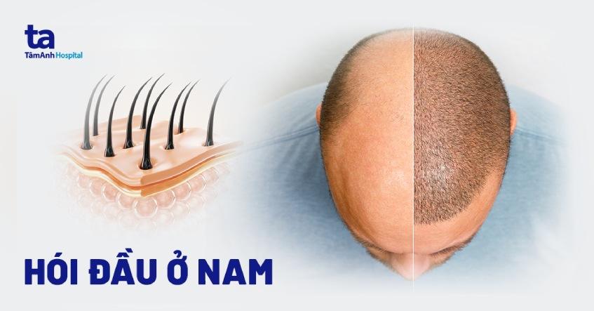 Hói đầu ở nam giới: Nguyên nhân, triệu chứng, chẩn đoán, phòng ngừa