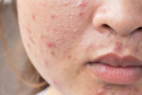 Top 12 serum cho da dầu mụn lỗ chân lông to trị mụn tốt nhất