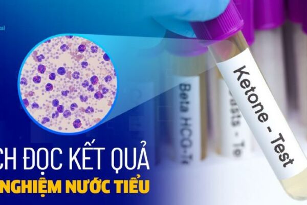 Hướng dẫn cách đọc kết quả xét nghiệm nước tiểu dễ hiểu nhất