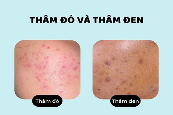 Vết thâm mụn có tự hết không? 5 Cách trị thâm an toàn - Viện Thẩm Mỹ KangJin