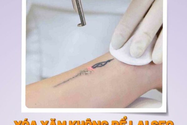 Xóa xăm không để lại sẹo bằng laser và những điều cần biết Xóa xăm không để lại sẹo bằng laser và những điều cần biết