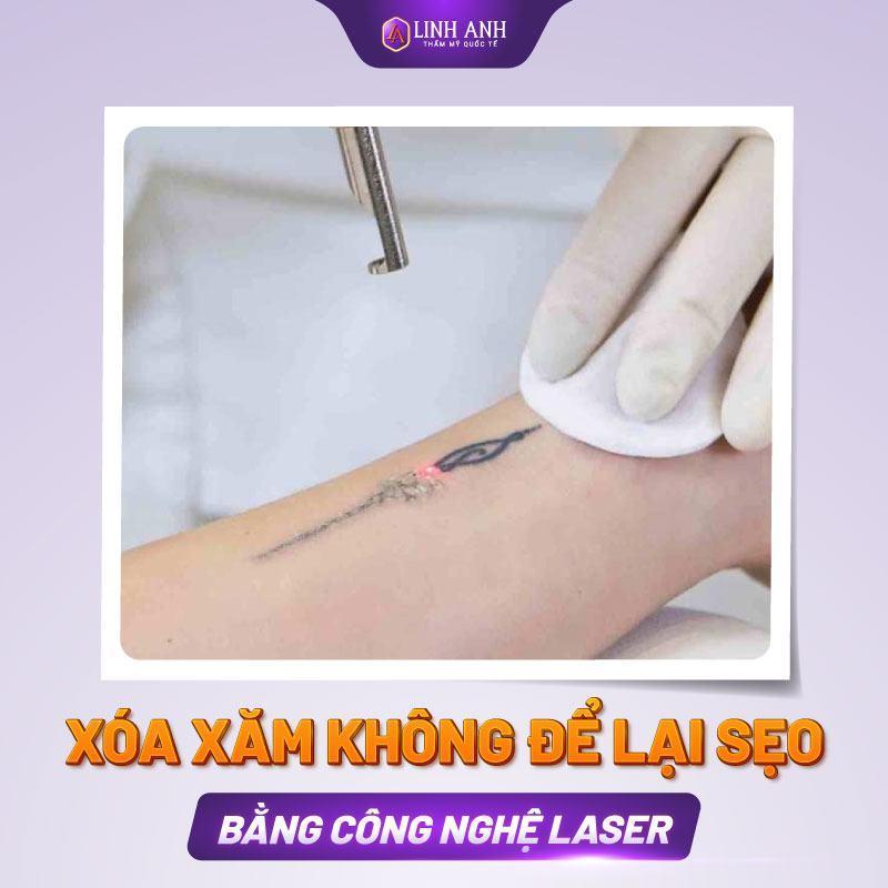 Xóa xăm không để lại sẹo bằng laser và những điều cần biết