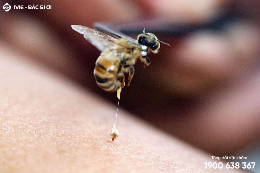 7 Bước xử lý vết ong đốt được bác sĩ khuyên thực hiện