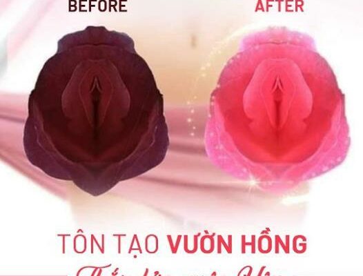 Chi Phí Làm Hồng Vùng Kín Là Bao Nhiêu Tiền?