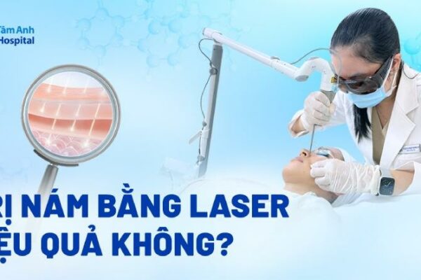Bắn laser trị nám có hiệu quả không? Khi nào nên lựa chọn?