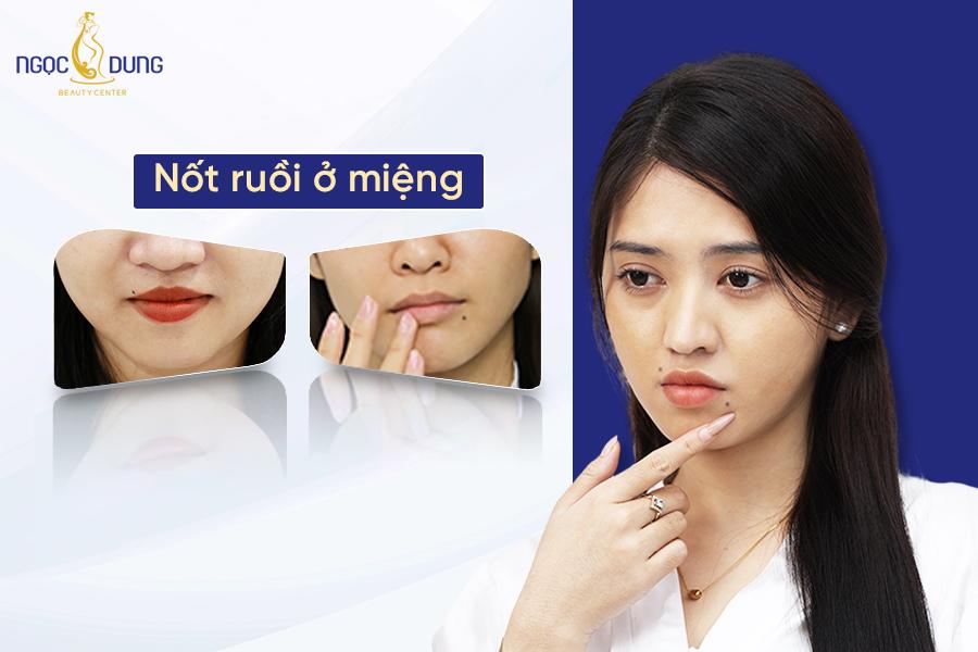 Số người có nốt ruồi ở miệng Hung hay Cát? Có nên tẩy không?