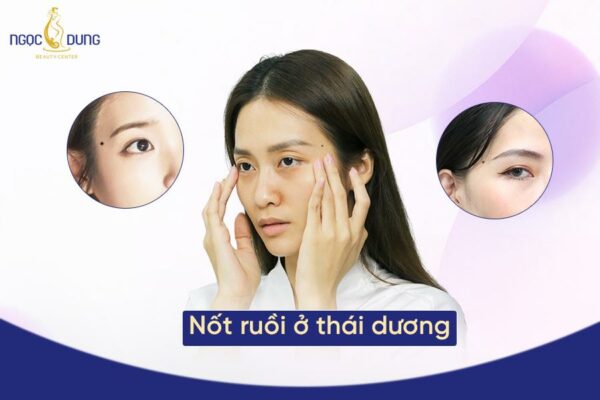 Giải mã bí ẩn nốt ruồi ở thái dương: Phúc hay họa, may hay rủi?