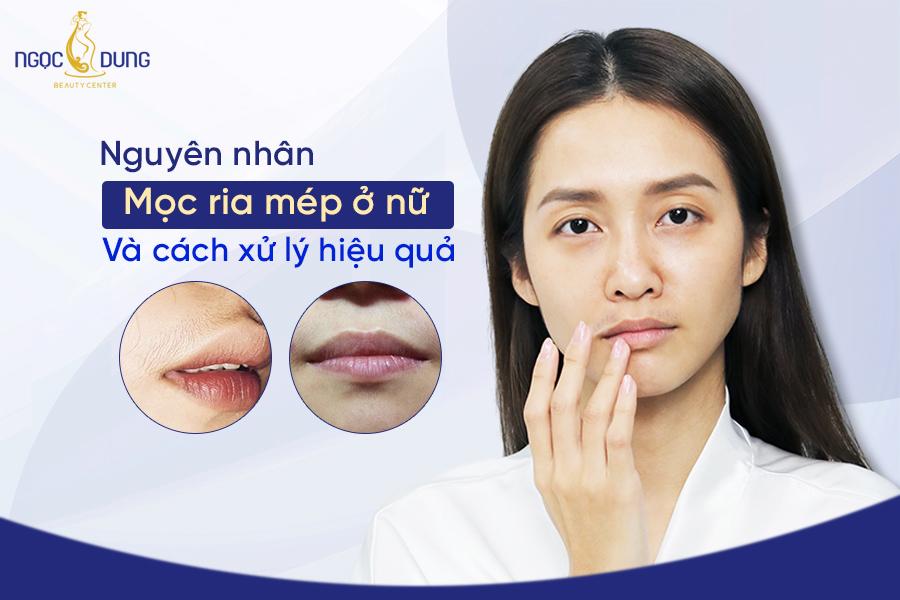 Nguyên nhân ria mép con gái mọc rậm và cách xử lý hiệu quả