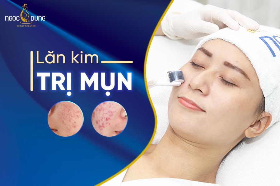 Lăn kim trị mụn là gì? Có tốt không? Hết bao nhiêu tiền?