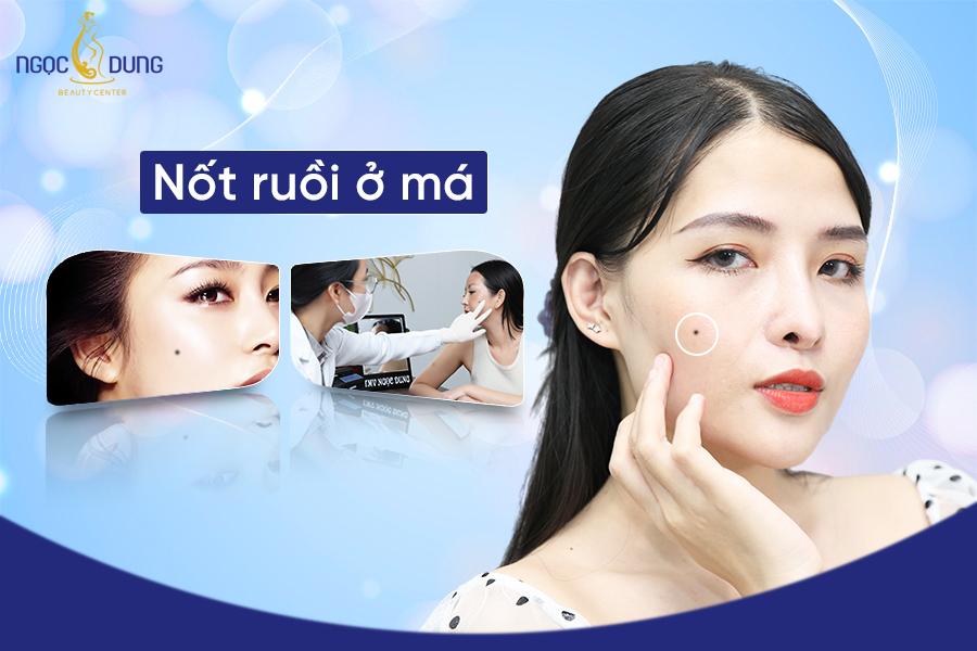 Nốt ruồi ở má nam, nữ là phúc lộc hay tai họa? Nên xóa không?