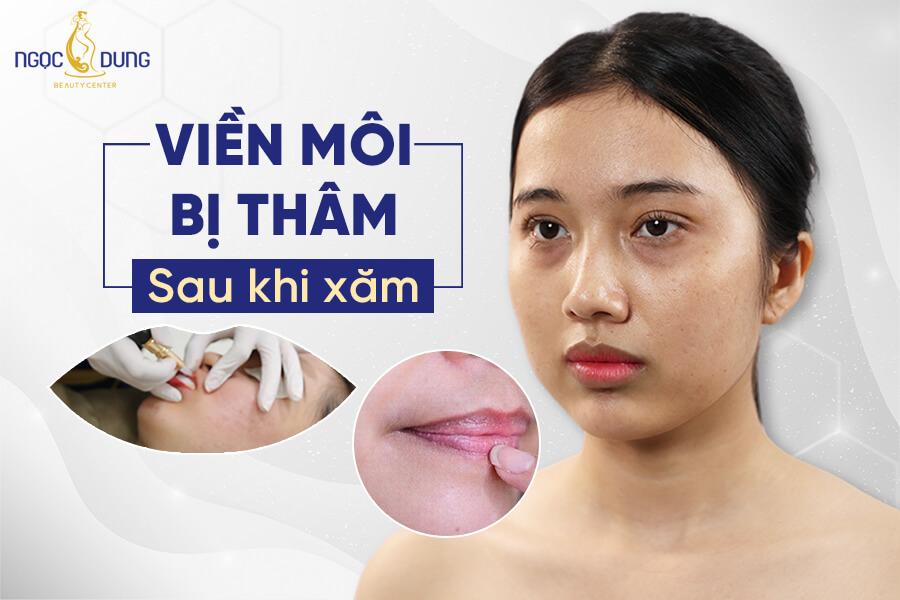 7 Cách chữa viền môi bị thâm sau khi xăm hiệu quả và dứt điểm